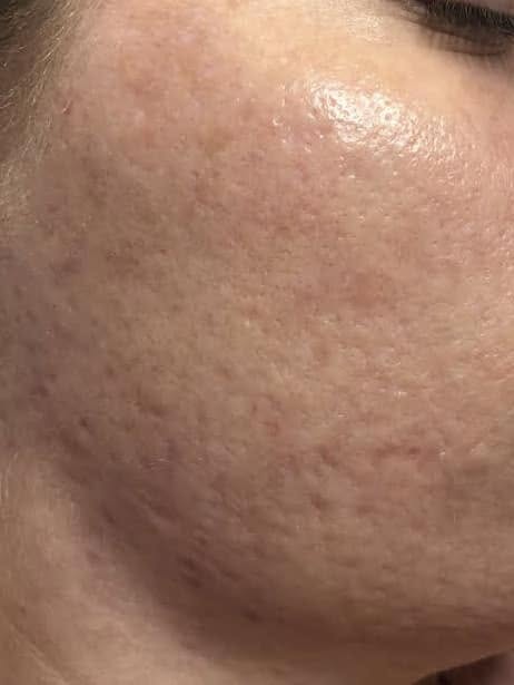 face showing acne before treatment and clear skin after treatment.