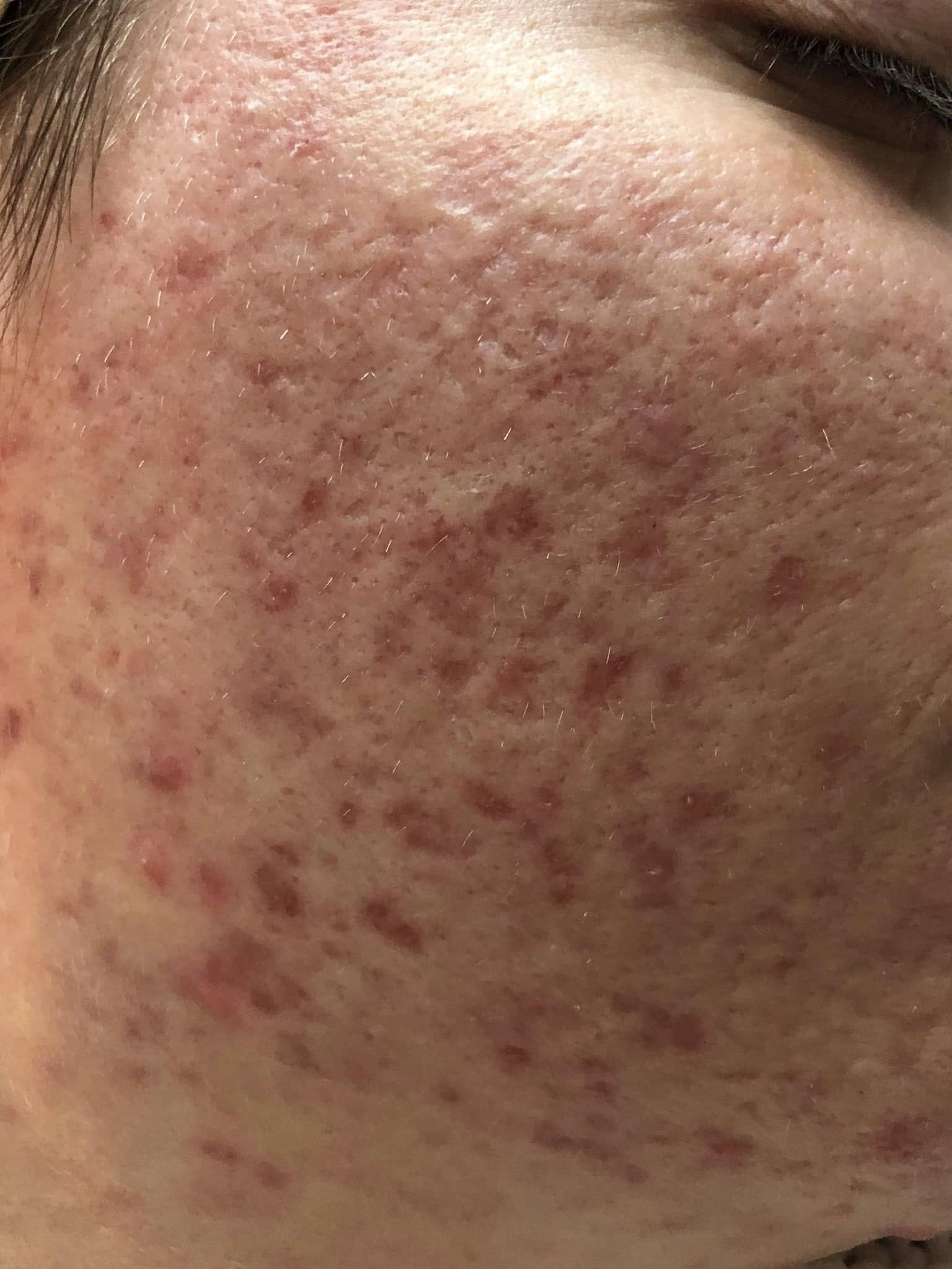 face showing acne, highlighting his skin texture and expression.