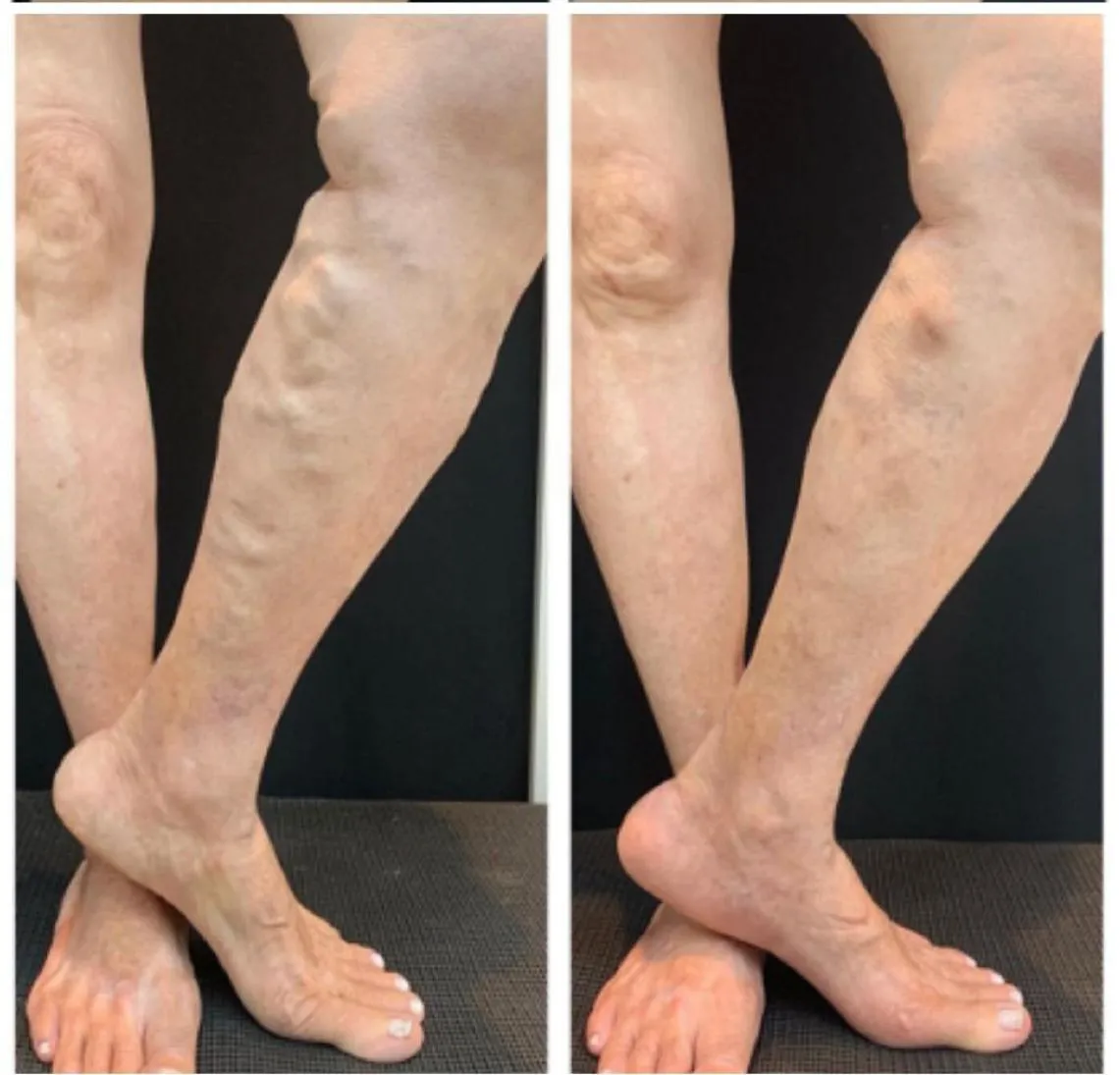 Resultado de paciente - Blefaroplastia