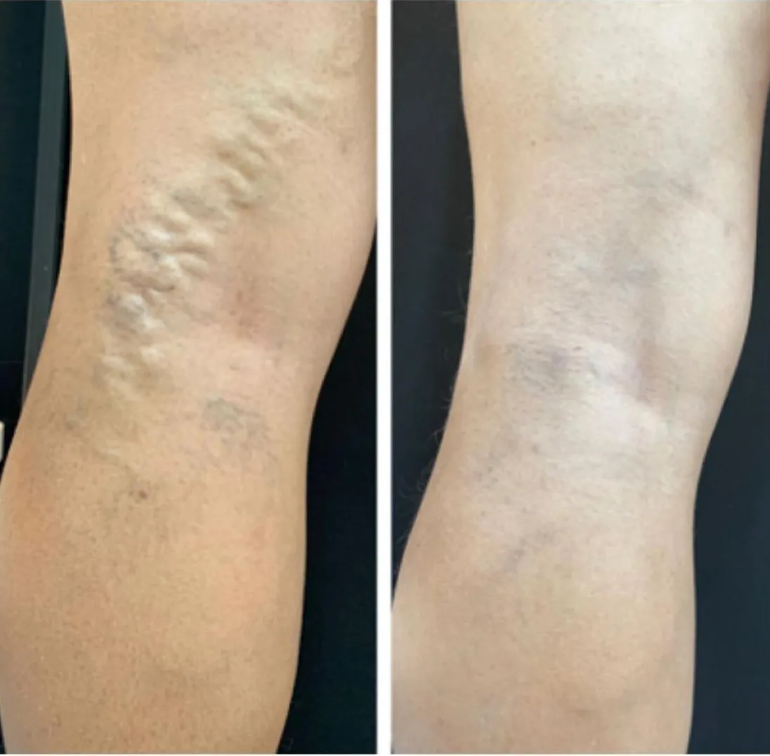 Resultado de paciente - Mamoplastia