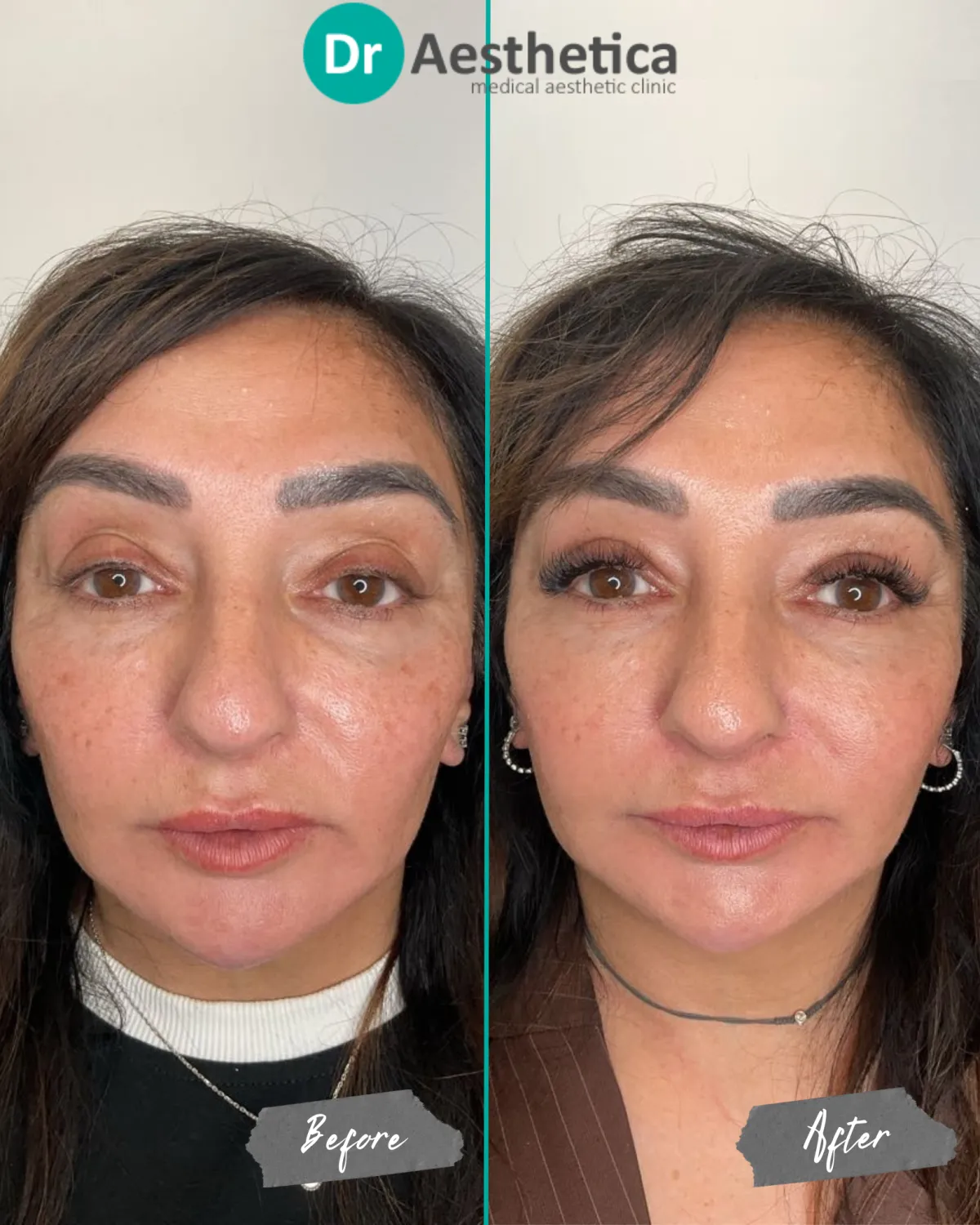 Before and after results of Collagen Kickstart radiofrequency microneedling in Birmingham, showing softened fine lines, firmer skin, and improved overall skin quality.