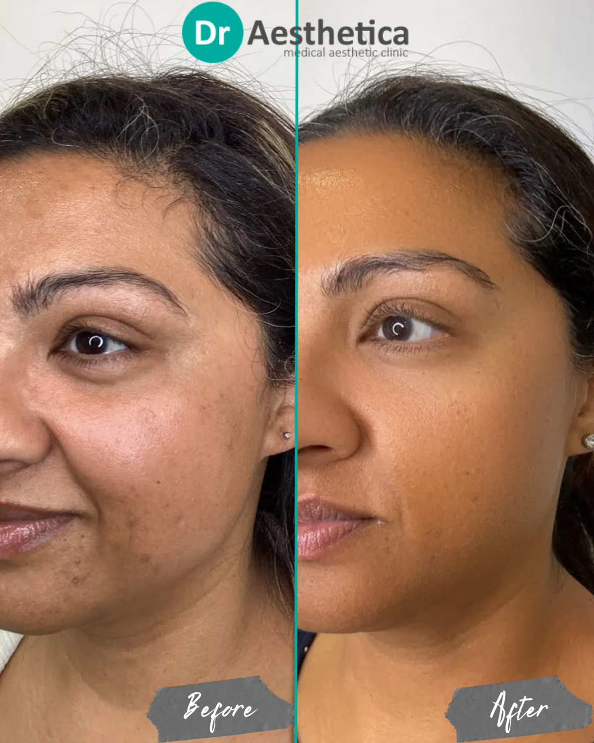 Patient after Collagen Kickstart RF microneedling treatment at Dr. Aesthetica in Birmingham, showing a refreshed, radiant complexion and natural glow.