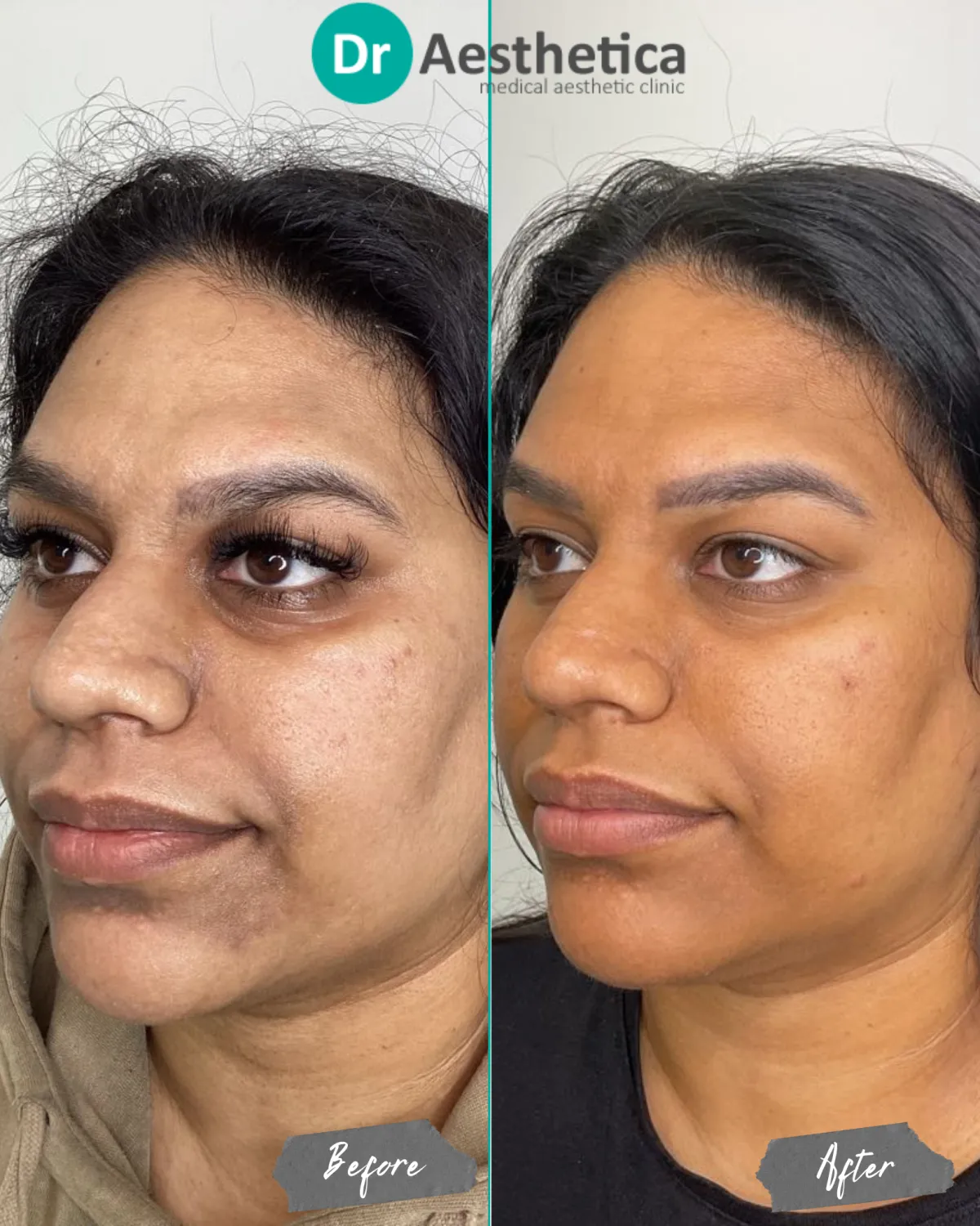 Microneedling result image 2