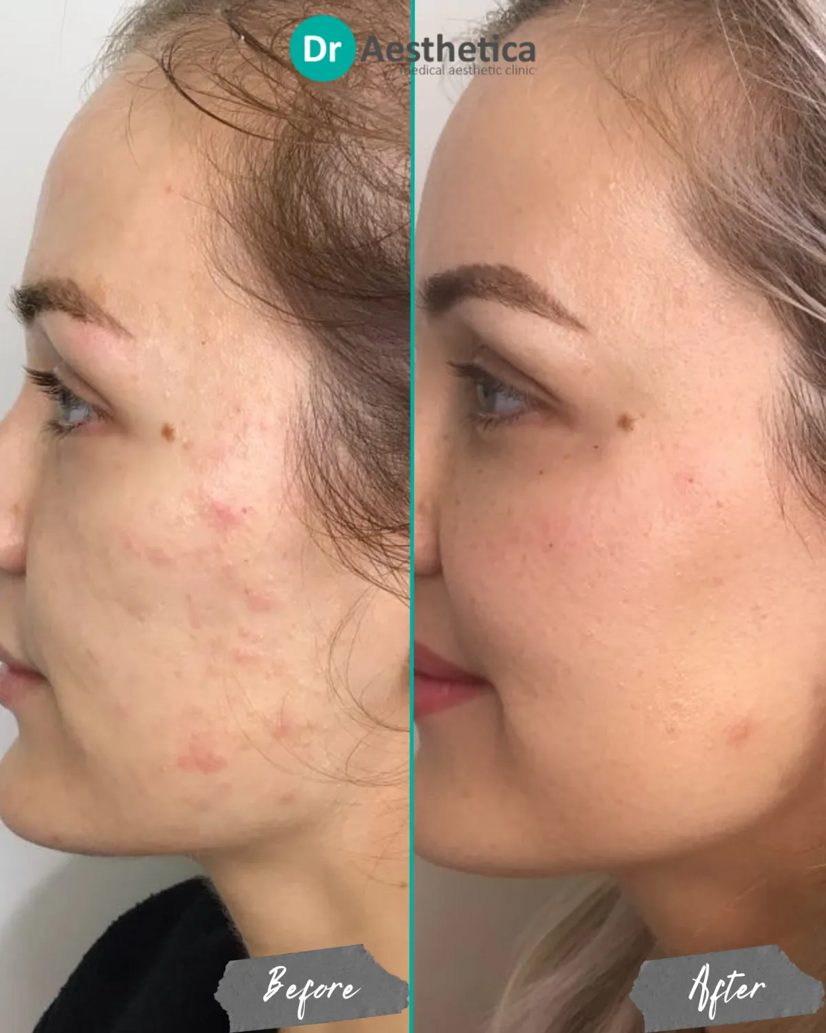 Microneedling result image 1