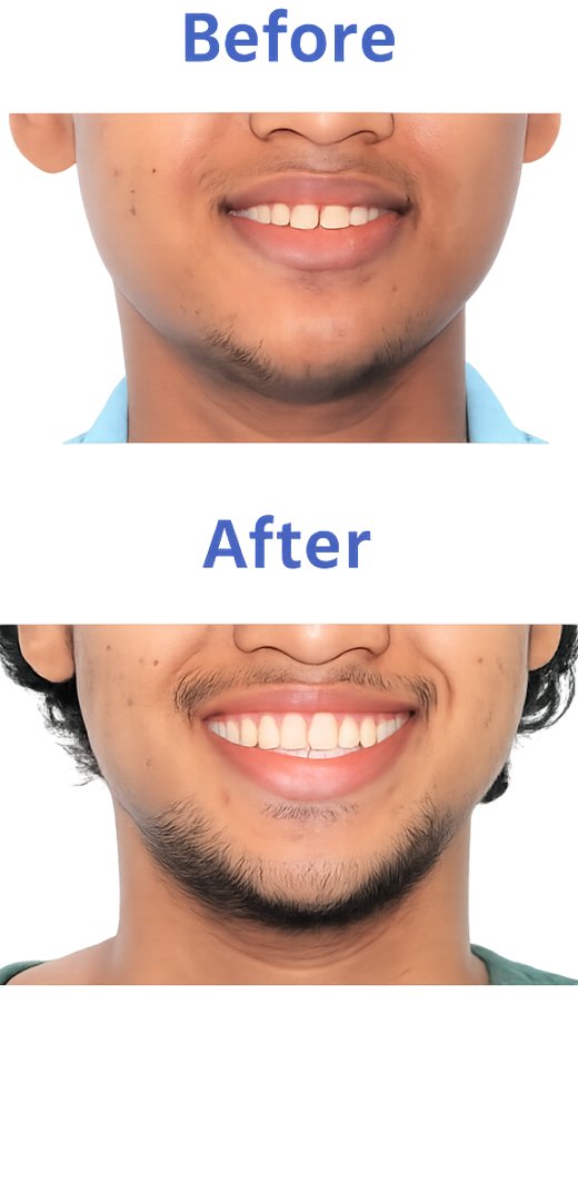 Patient smile transformation 1