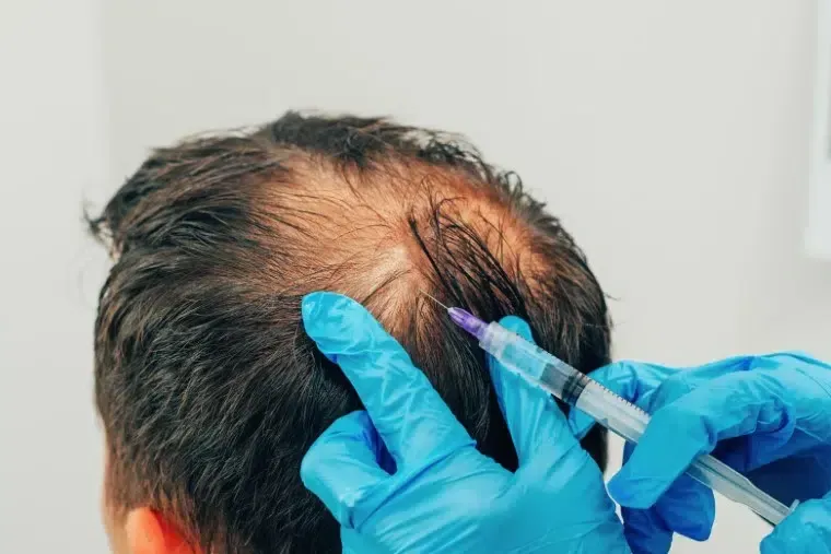 PRP Therapy Treatment