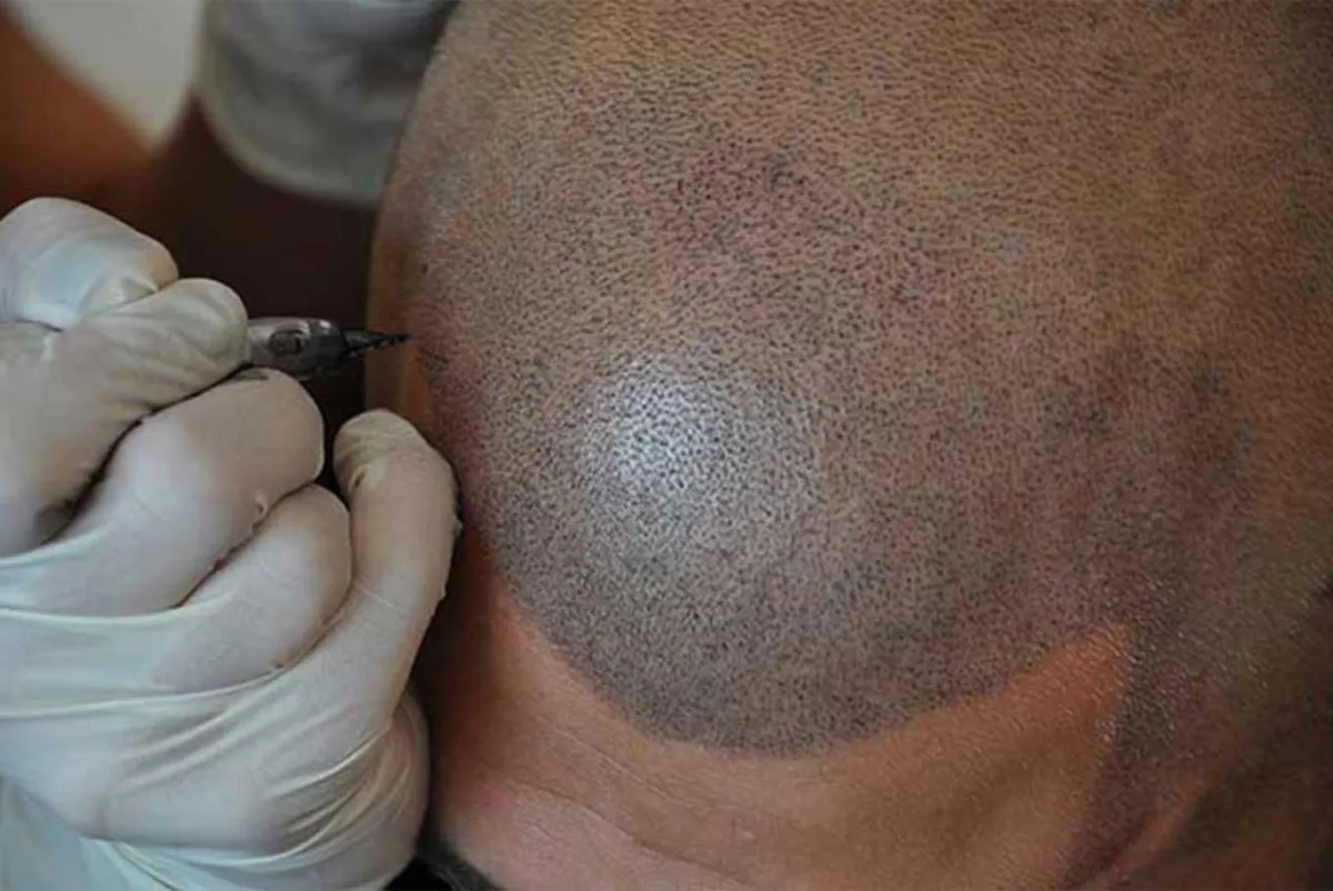 PRP Therapy Treatment