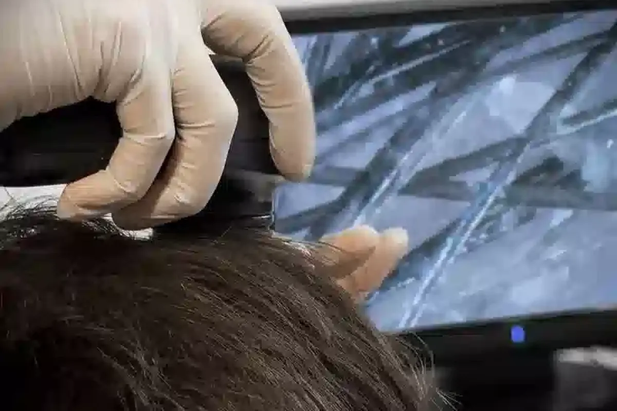 Trichoscopy Therapy