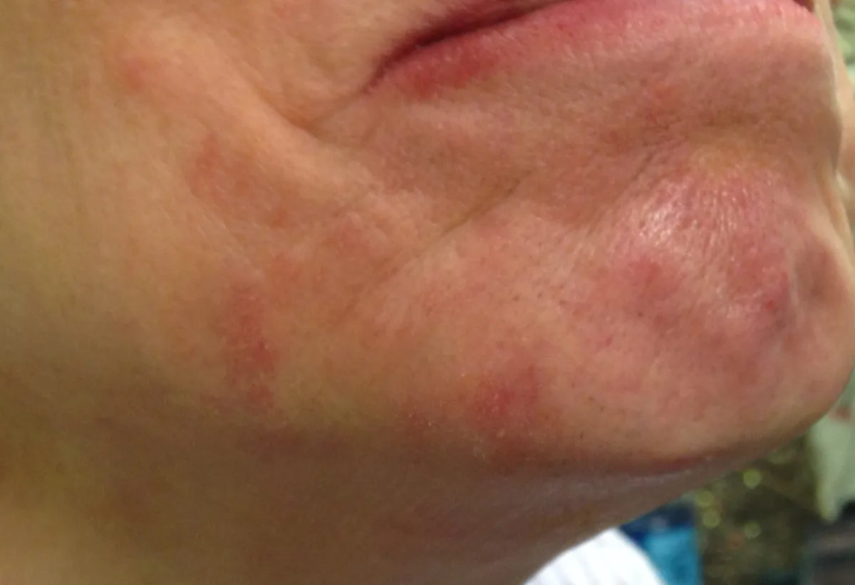 Acne, Inflammation, and Skin Conditions