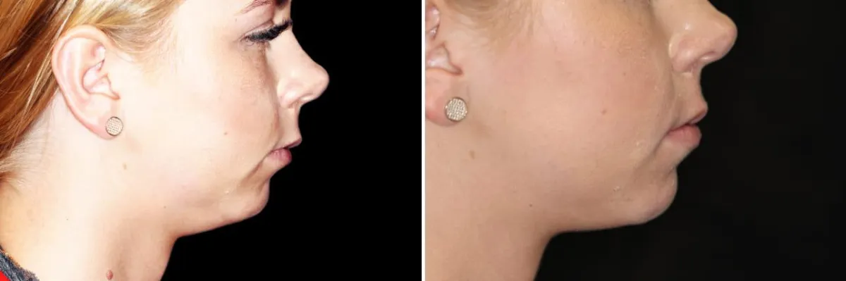 Porcelain Veneers Before and Afters