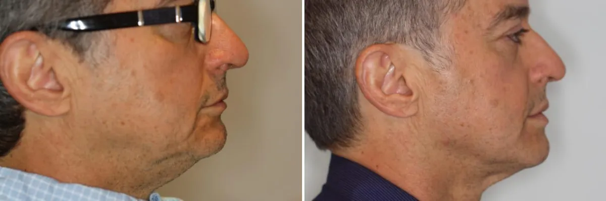 Veneers Before and Afters