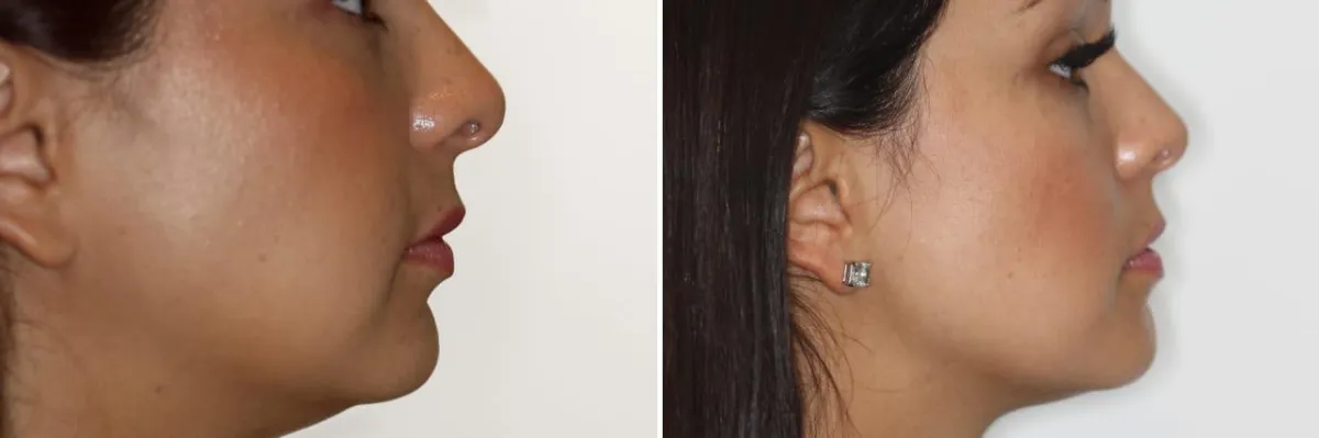 Veneers Before and After Process