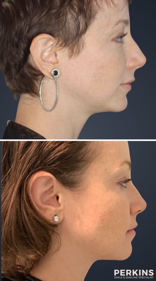 best porcelain veeners in los angeles