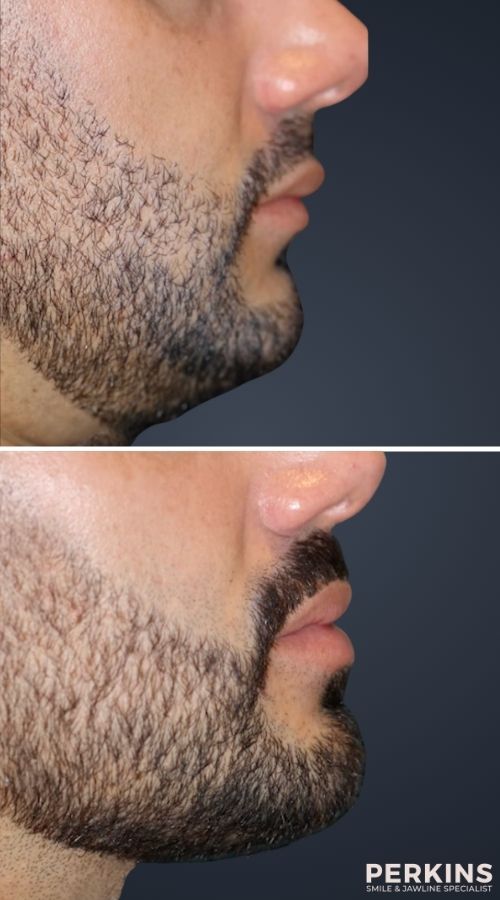 best porcelain veneers in malibu