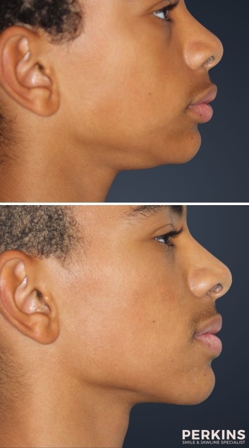 best porcelain veneers in los angeles