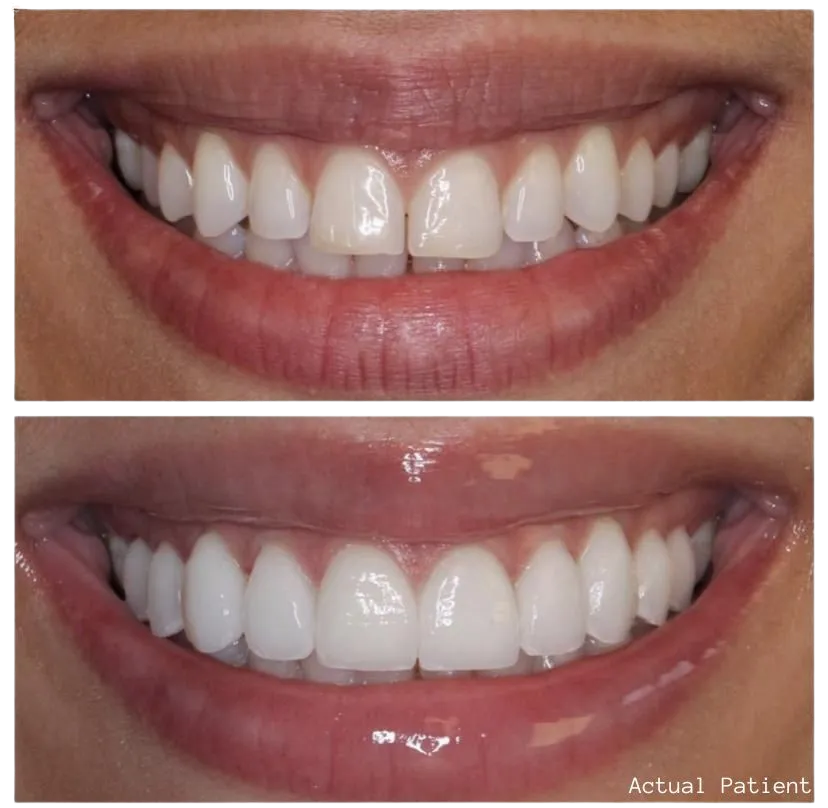 best porcelain veneers in los angeles
