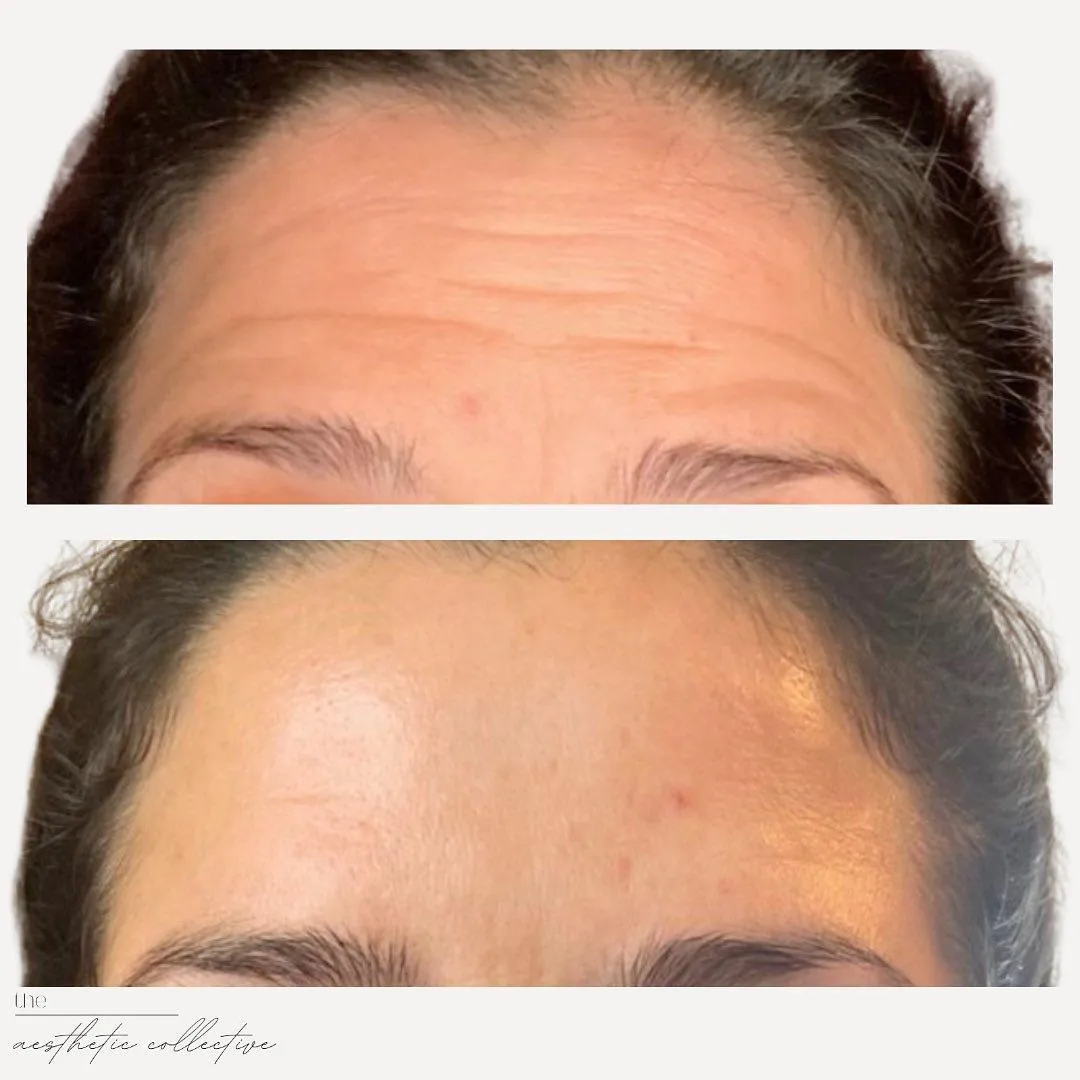 A before and after photo of a woman's forehead. The top image shows the forehead deep wrinkles, whereas the bottom photo shows the forehead free of wrinkles and after Sculptra injection treatment.