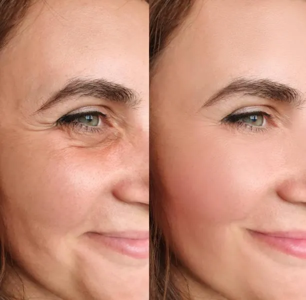 A before and after photo of a woman's side profile. The left image is before, with wrinkles around the eyes and mouth. The right image is after Sculptra injections, showing a reduction in deep wrinkles lines.