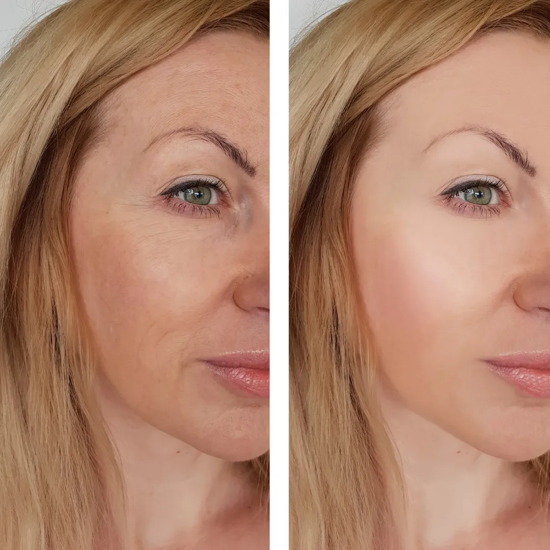 A before and after photo of a woman's side profile. The left image is before Sculptra fillers, with loss of collagen. The right image is after treatment, showing more youthful skin.