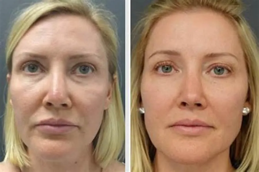 A before and after of a woman after receiving dermal facial fillers from the aesthetic collective in Bastrop, Texas.