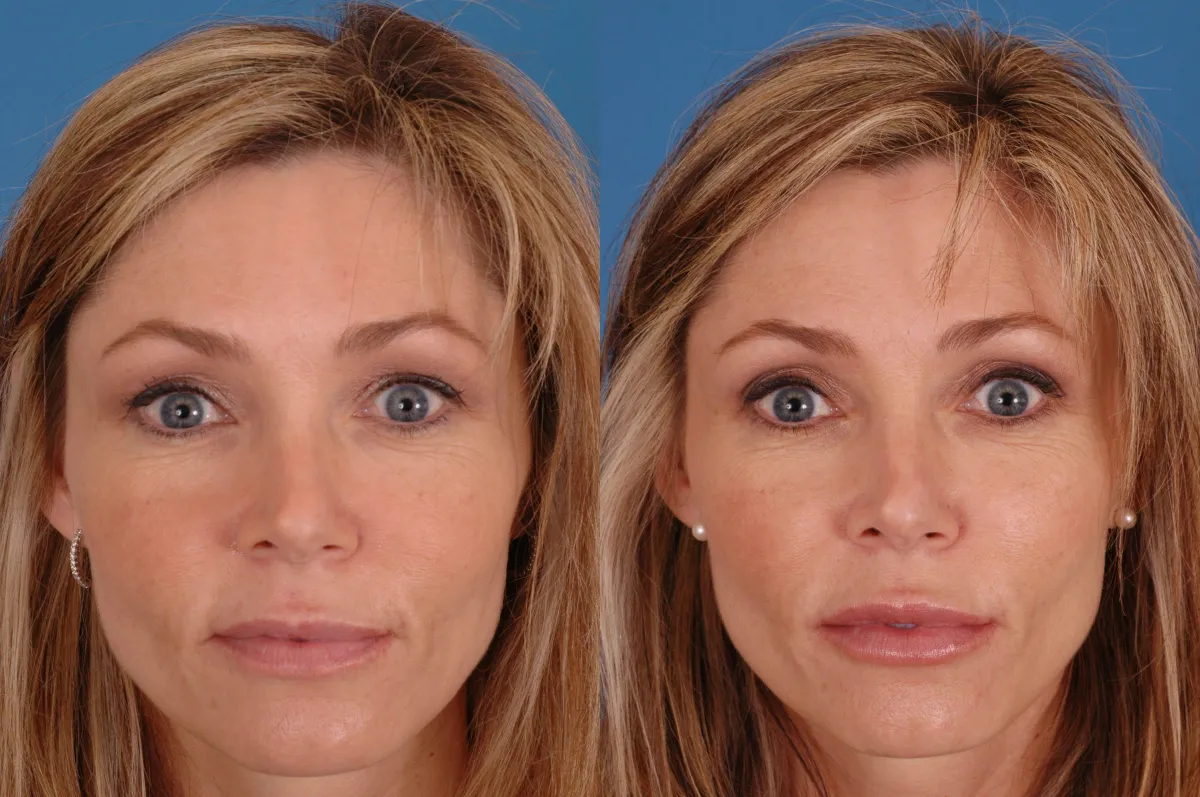 A before and after of a woman after receiving dermal facial fillers.