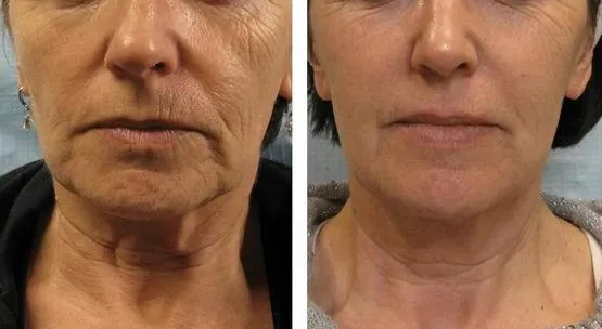 A before and after photo of a woman who received TIXEL treatment.