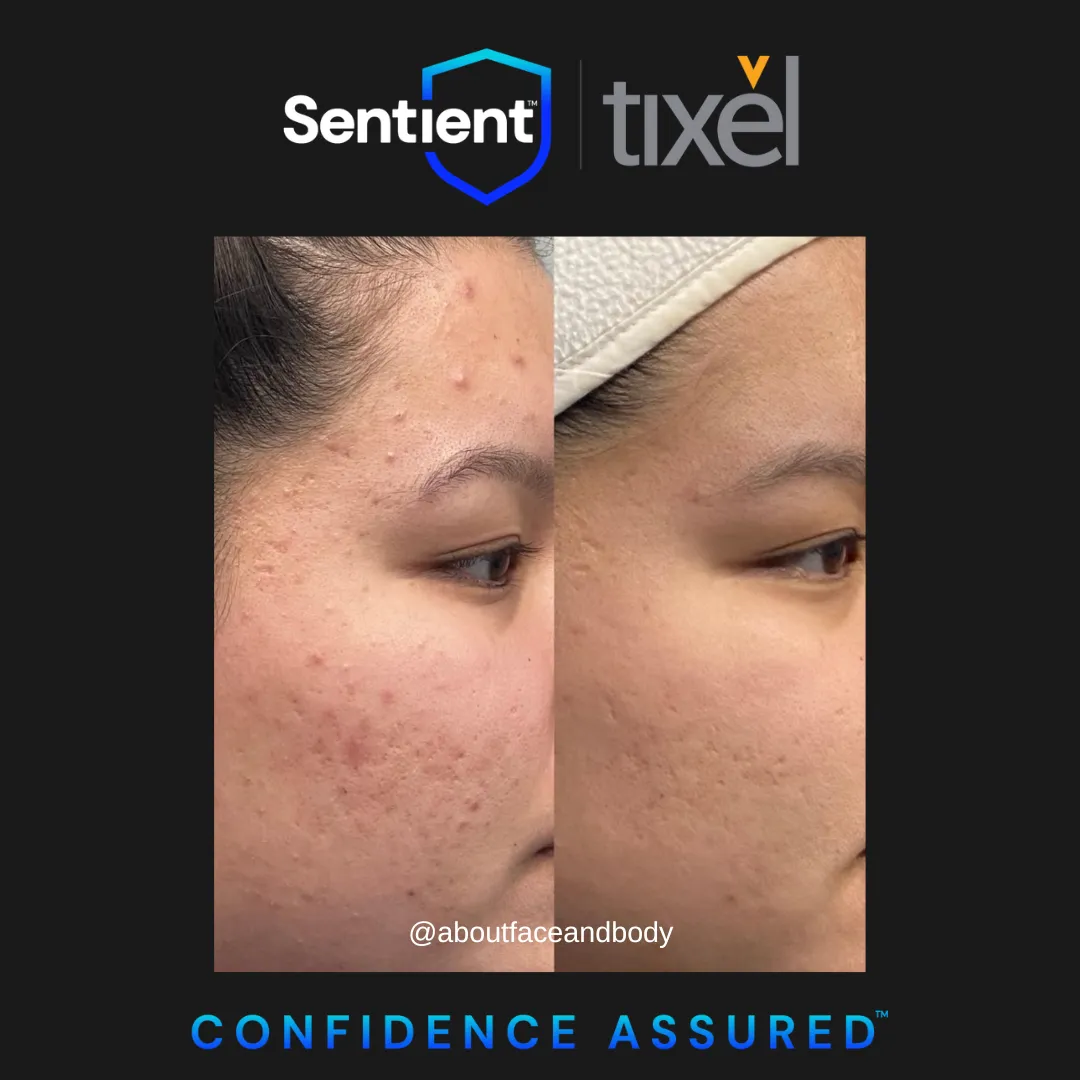 A before and after image of acne scarring on the face treated with TIXEL.