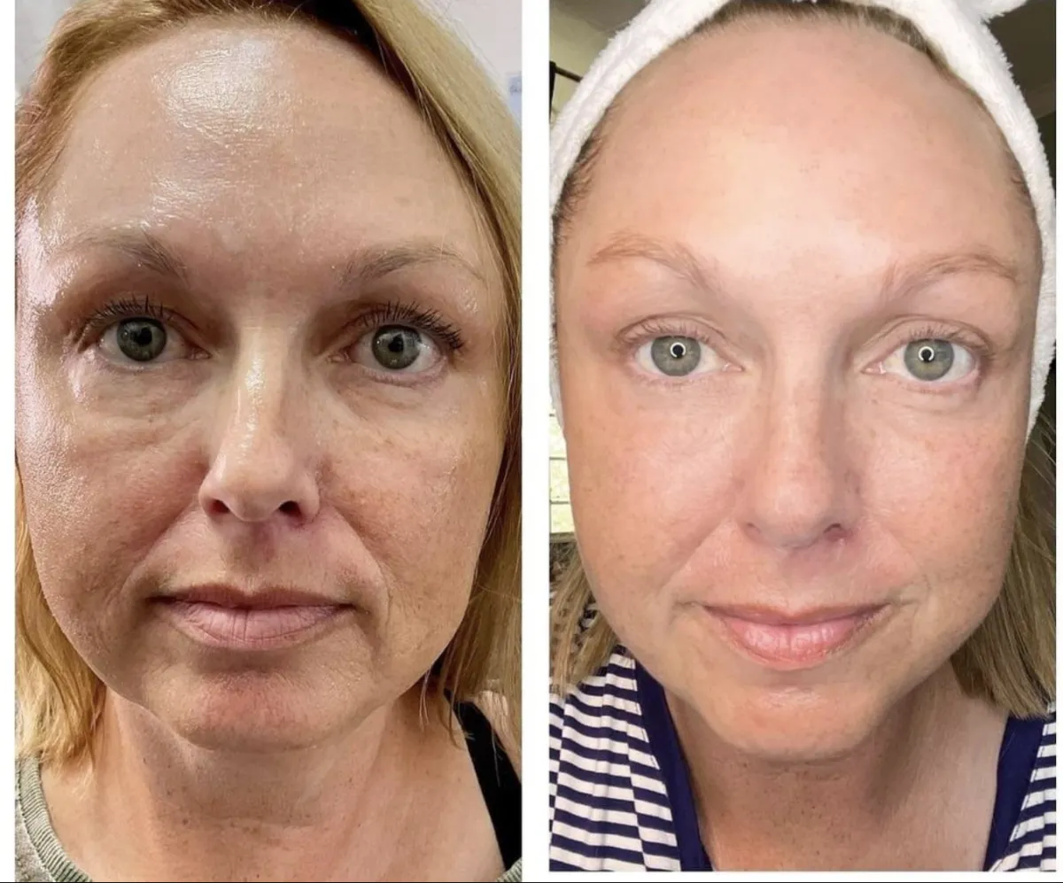 A photo of a woman before and after skin resurfacing for crepey, aging skin.