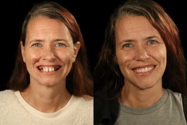 Dental Imiplants