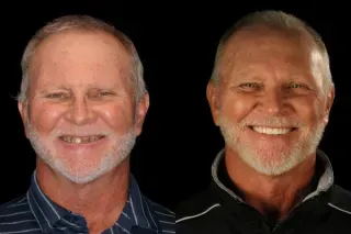 denture smile makeover