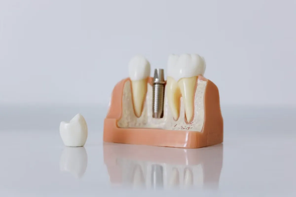 all on four dentures