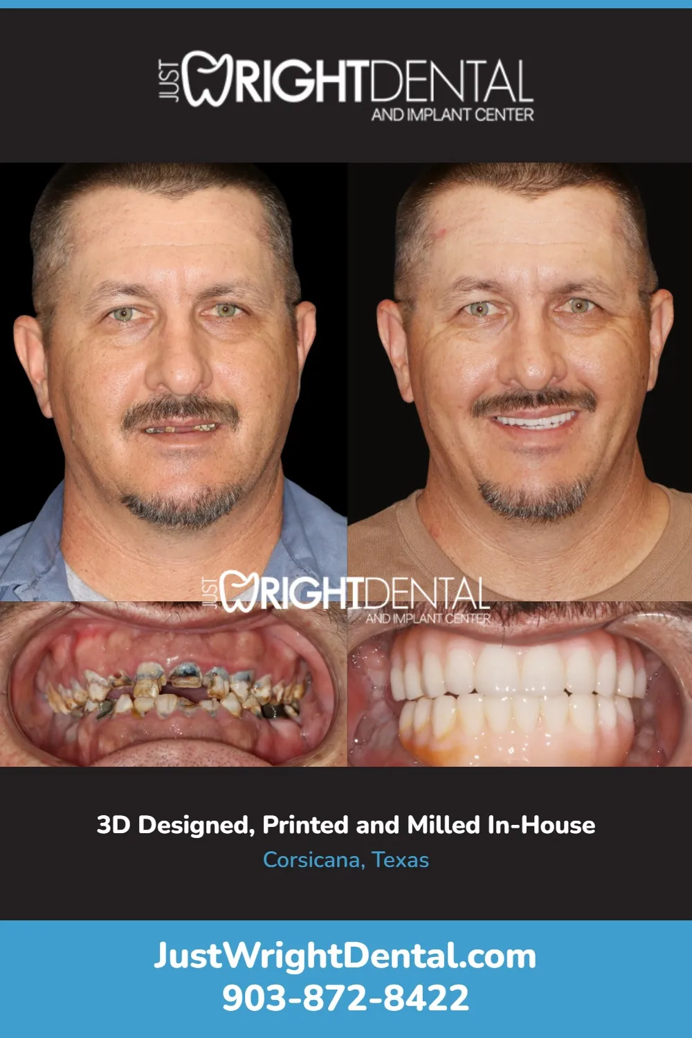 Person holding jaw in pain, a sign of dental implant rejection or failure requiring evaluation at Just Wright Dental and Implant Center in Corsicana, TX