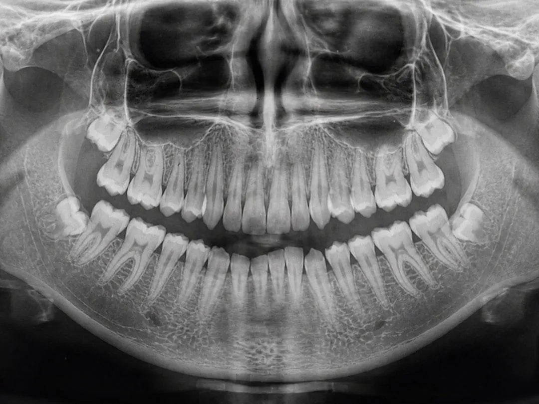 3D CBCT view of a dental implant and surrounding jawbone used to assess bone support