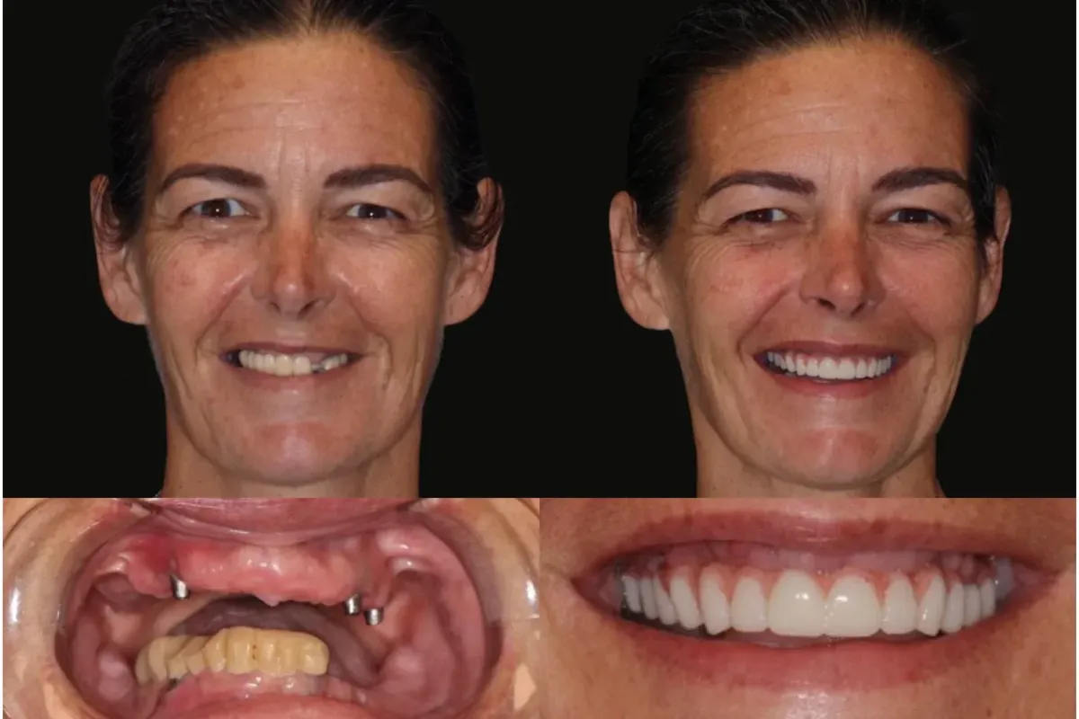 dental implant