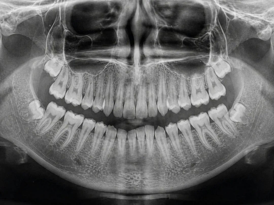 3D CBCT view of a dental implant and surrounding jawbone used to assess bone support