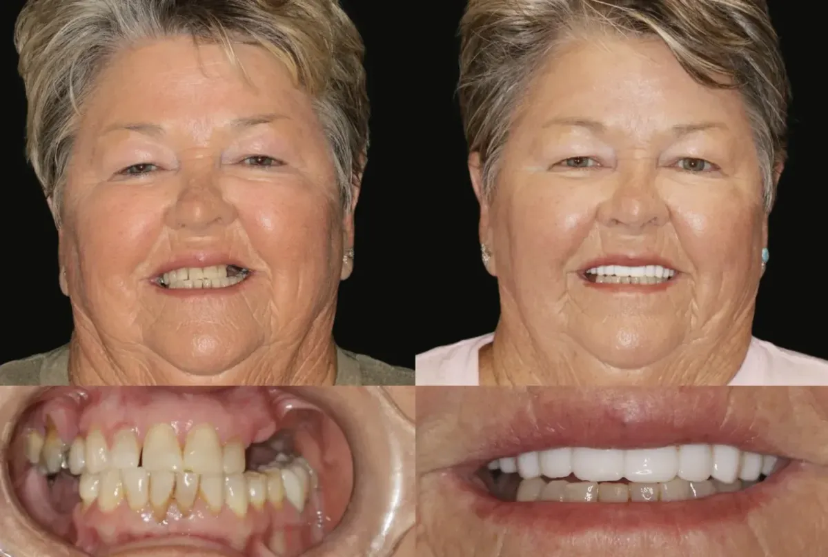 teeth whitening before after