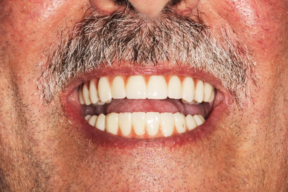 Full Mouth Implants Fiorentini Family Dentistry Monroe Township & Highland Park, NJ