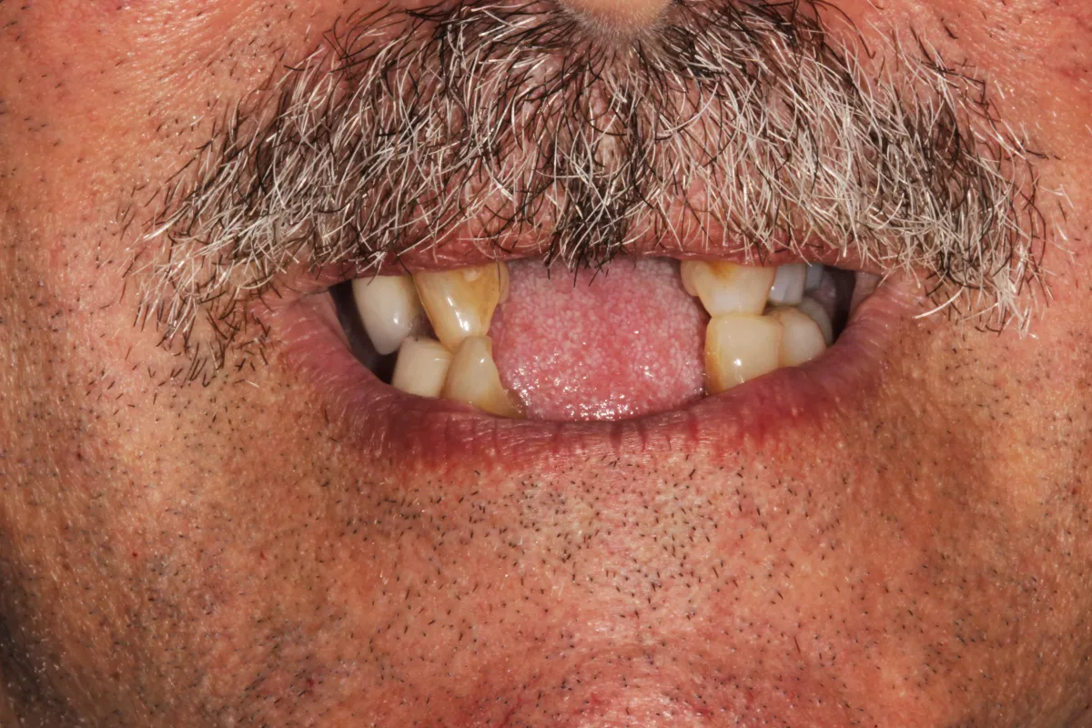 Full Mouth Implants Fiorentini Family Dentistry Monroe Township & Highland Park, NJ