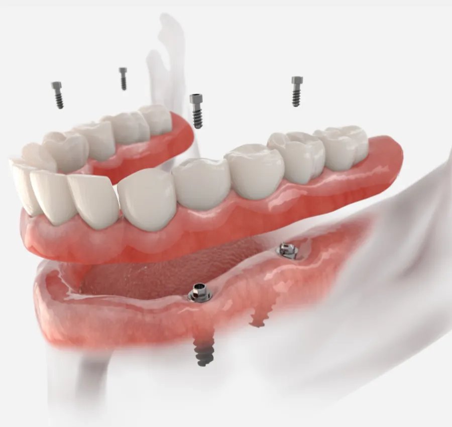 Full Mouth Implants Fiorentini Family Dentistry Monroe Township & Highland Park, NJ