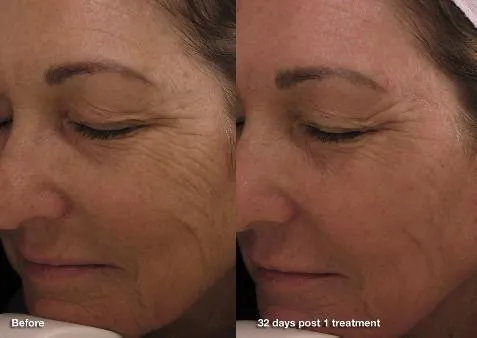 Deeper wrinkle correction with Pearl Fractional