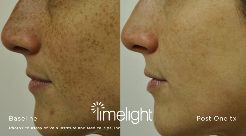 Even skin tone achieved through IPL treatment