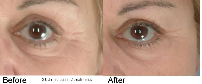 Upper and lower eye rejuvenation after Pearl resurfacing