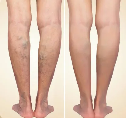 Sclerotherapy Treatment