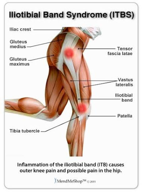 hip bursitis is commonly misdiagnosed for sciatica