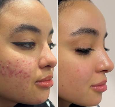 A before and after image showing a patient with improved skin from acne treatments