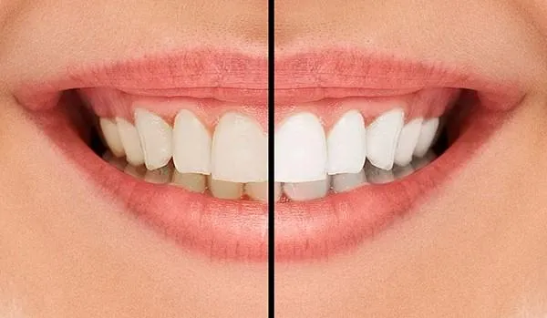 Teeth Whitening