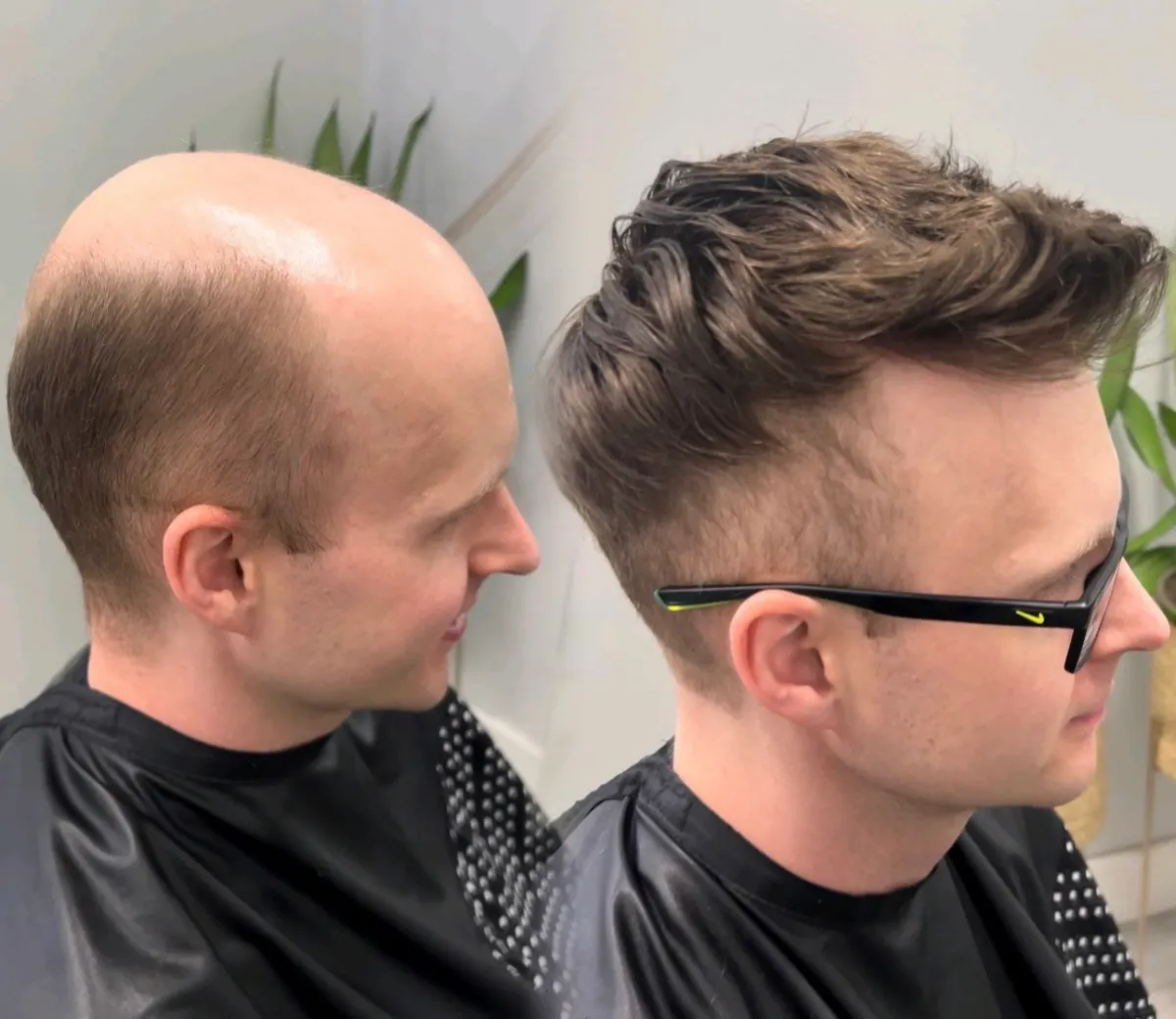 the best hair replacement new orleans