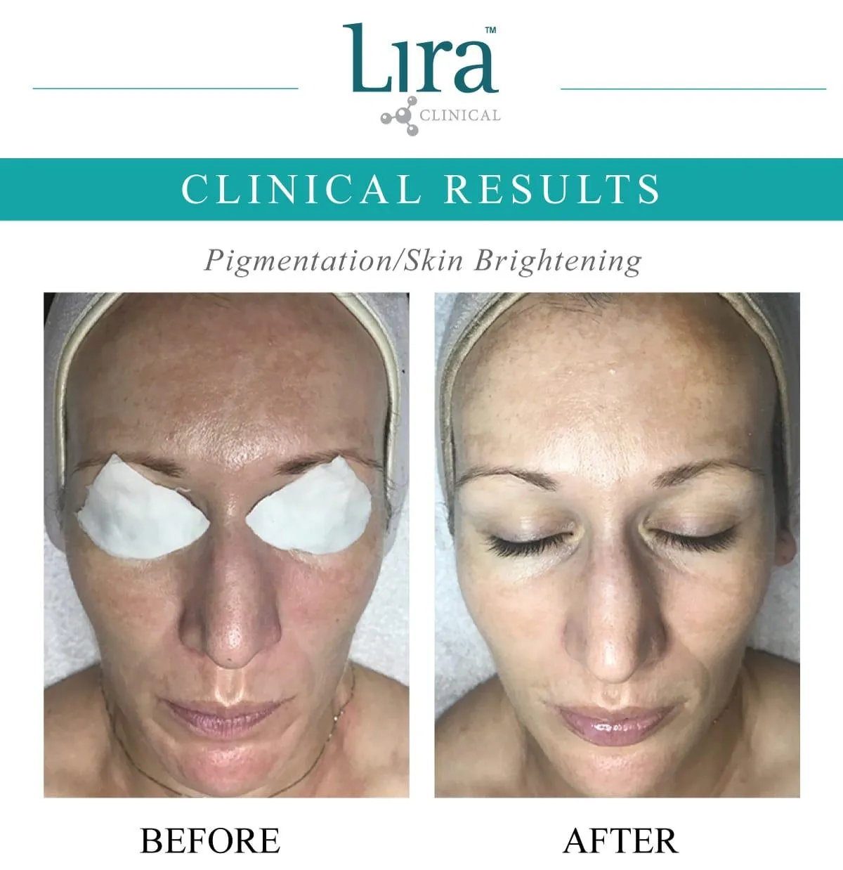 Lira Clinical Results - Skin Brightening