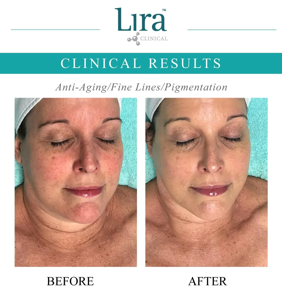 Lira Clinical - Rosacea