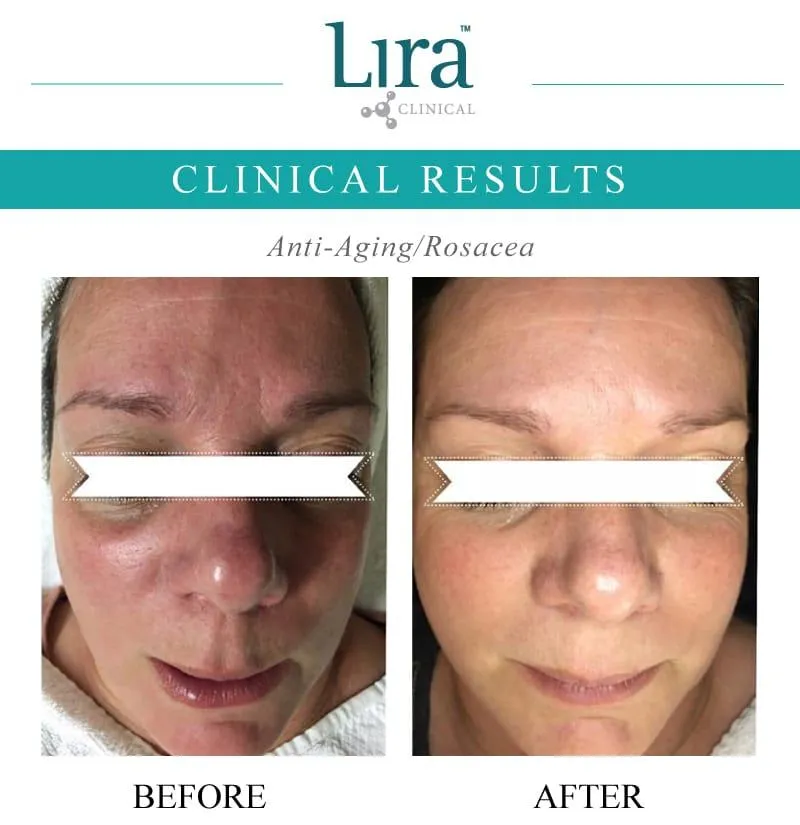 Lira Clinical - Rosacea
